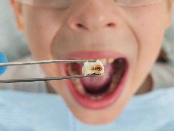 Best Knocked-Out Tooth (Avulsed Tooth) Treatment in Claryville, KY